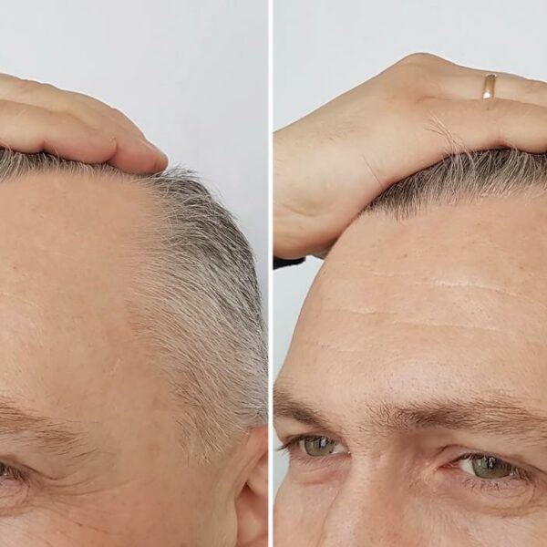 Tratamiento Capilar  Hybrid + Exosomas: Regeneración profunda para cuero cabelludo y cabello