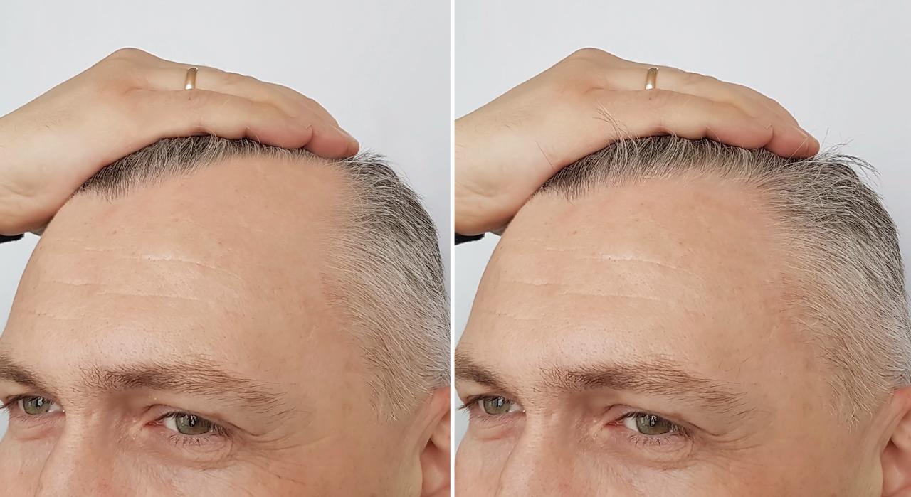 Tratamiento Capilar  Hybrid + Exosomas: Regeneración profunda para cuero cabelludo y cabello