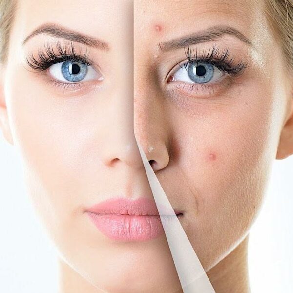 Peelings químicos secuenciales